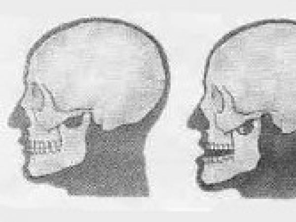 Как понять, что у человека произошел вывих челюсти
